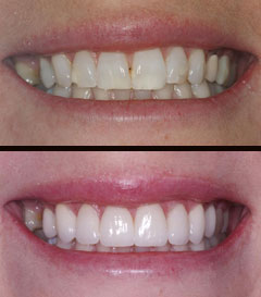 Veneers before after