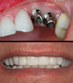 dental implants before after