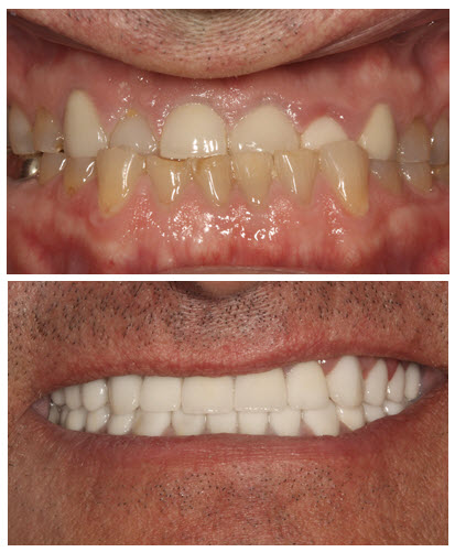 Full mouth reconstruction before after