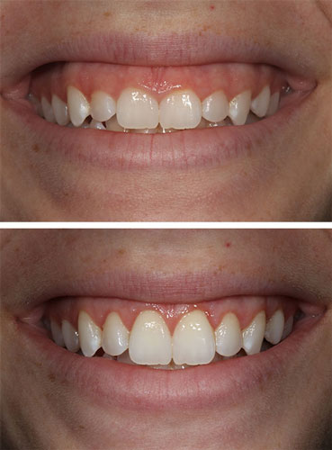 Gum contouring before after