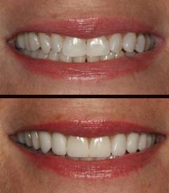 Smile makeover before after